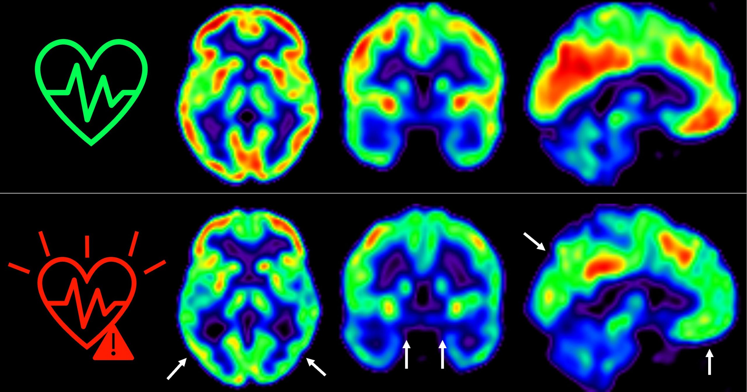 Las imágenes representan la captación de glucosa en cerebro medida por tomografía.